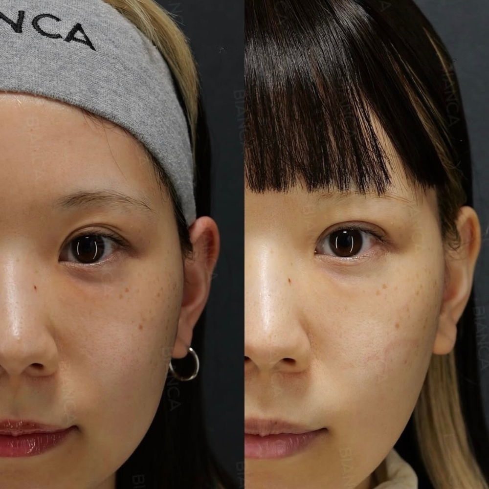 二重埋没法（裏留め）B TWICE