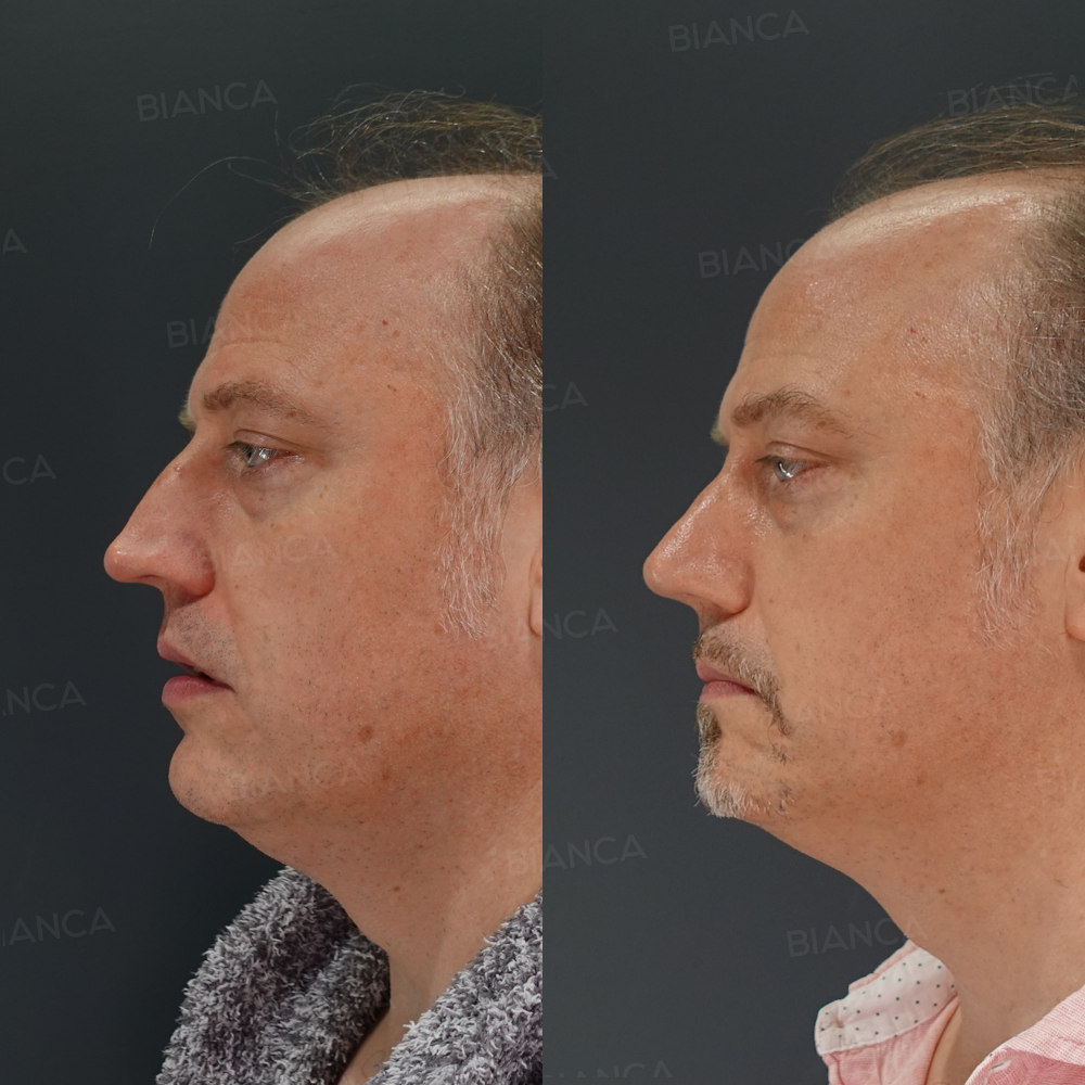 鼻尖縮小、鼻尖形成、ハンプ切除、鼻骨骨切り術