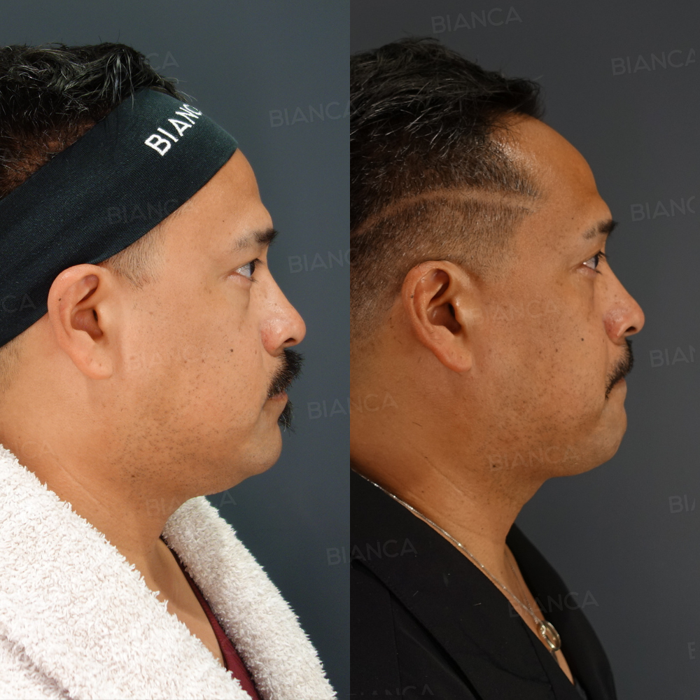 エンブレイスRF (フェイスタイト顎下）、脂肪吸引(顎下）、モフィウス8