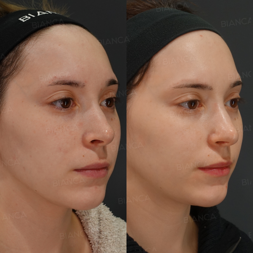 鼻骨骨切り術、鼻尖形成、鼻孔縁下降術