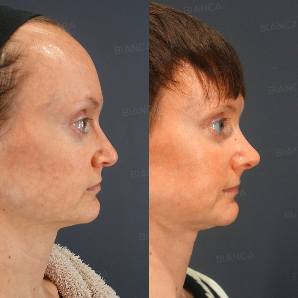 鼻尖形成、鼻尖部軟骨移植、鼻尖縮小、BIANCA LIFT