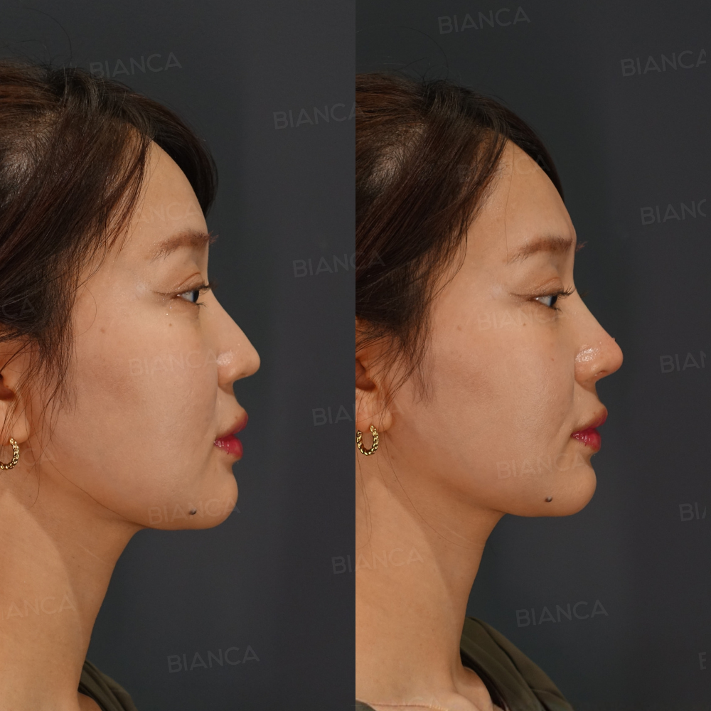 ヒアルロン酸注射（鼻）