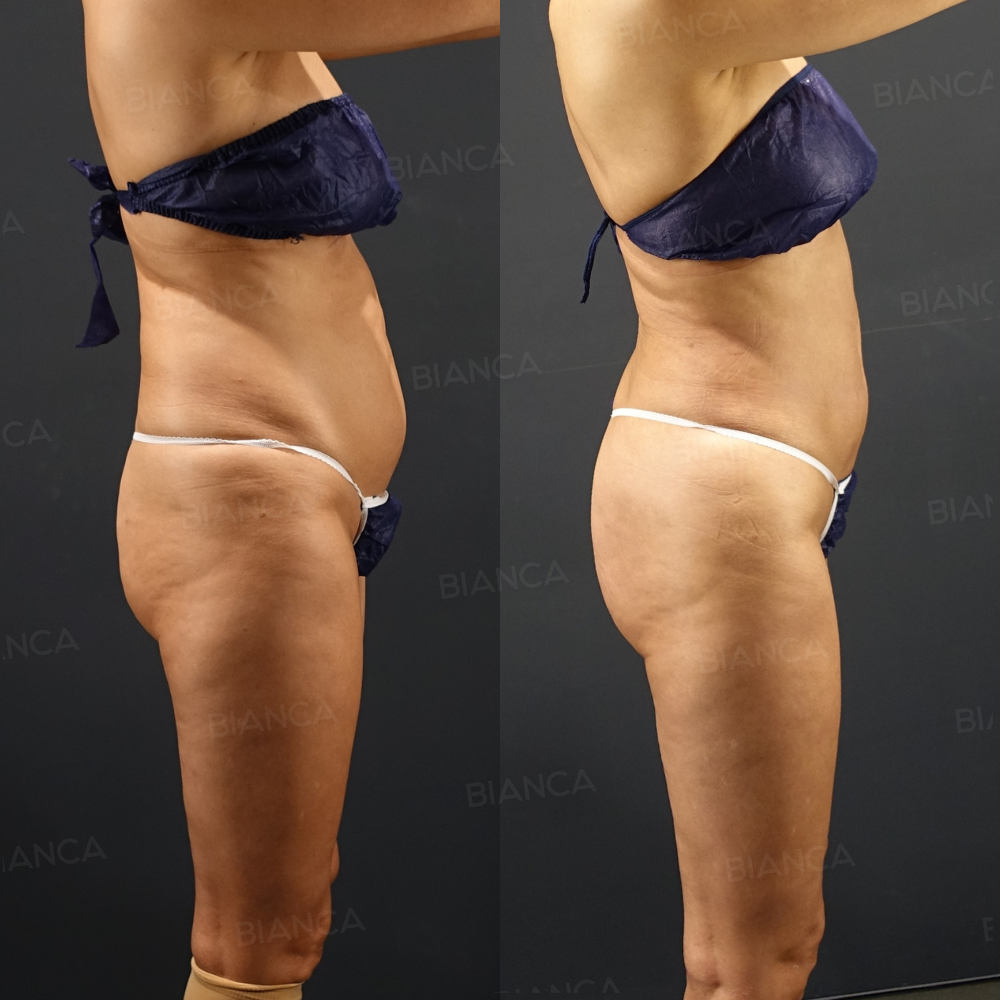 豊尻術 (ブラジリアンバットリフト)