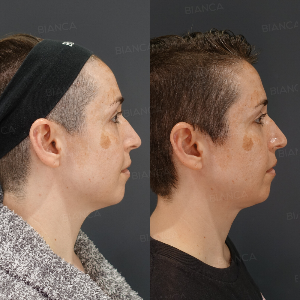 エンブレイスRF、脂肪吸引、モフィウス8