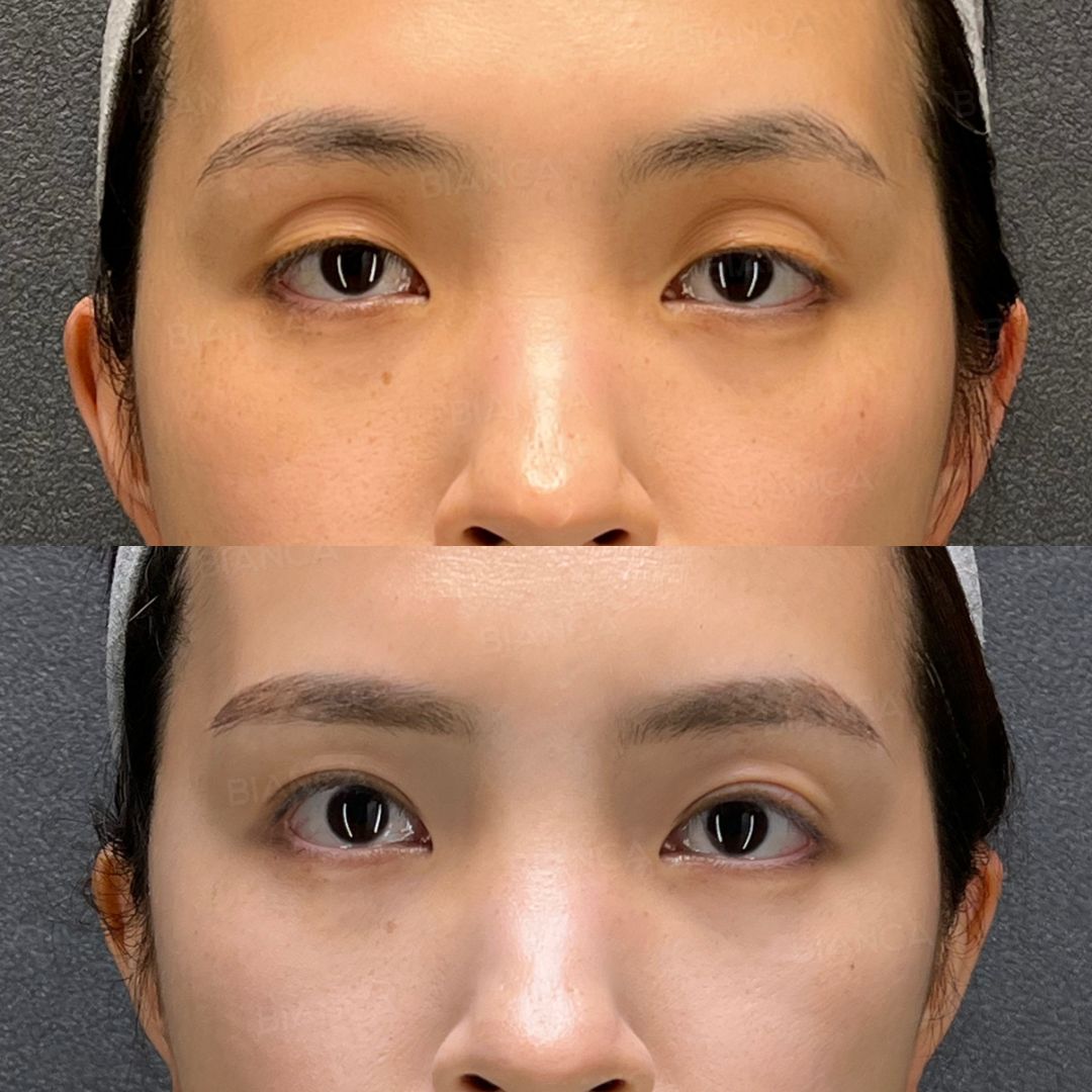 眼瞼下垂切開法