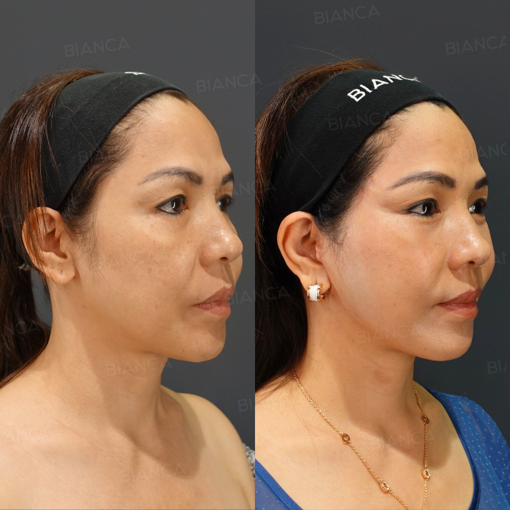 こめかみリフト、ディーププレーンリフト、ネックリフト