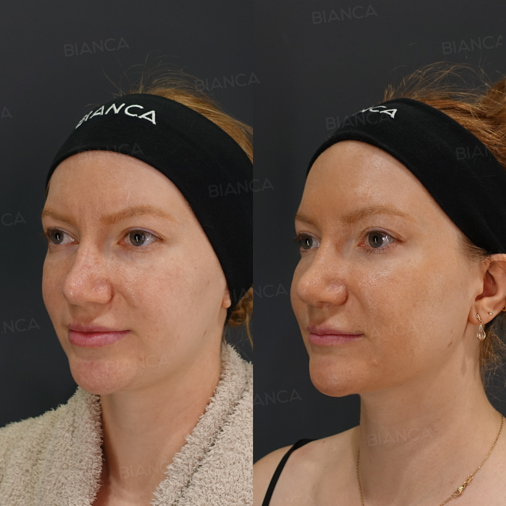 エンブレイスRF（フェイスタイト頬/顎下）、脂肪吸引(顎下)、モフィウス8