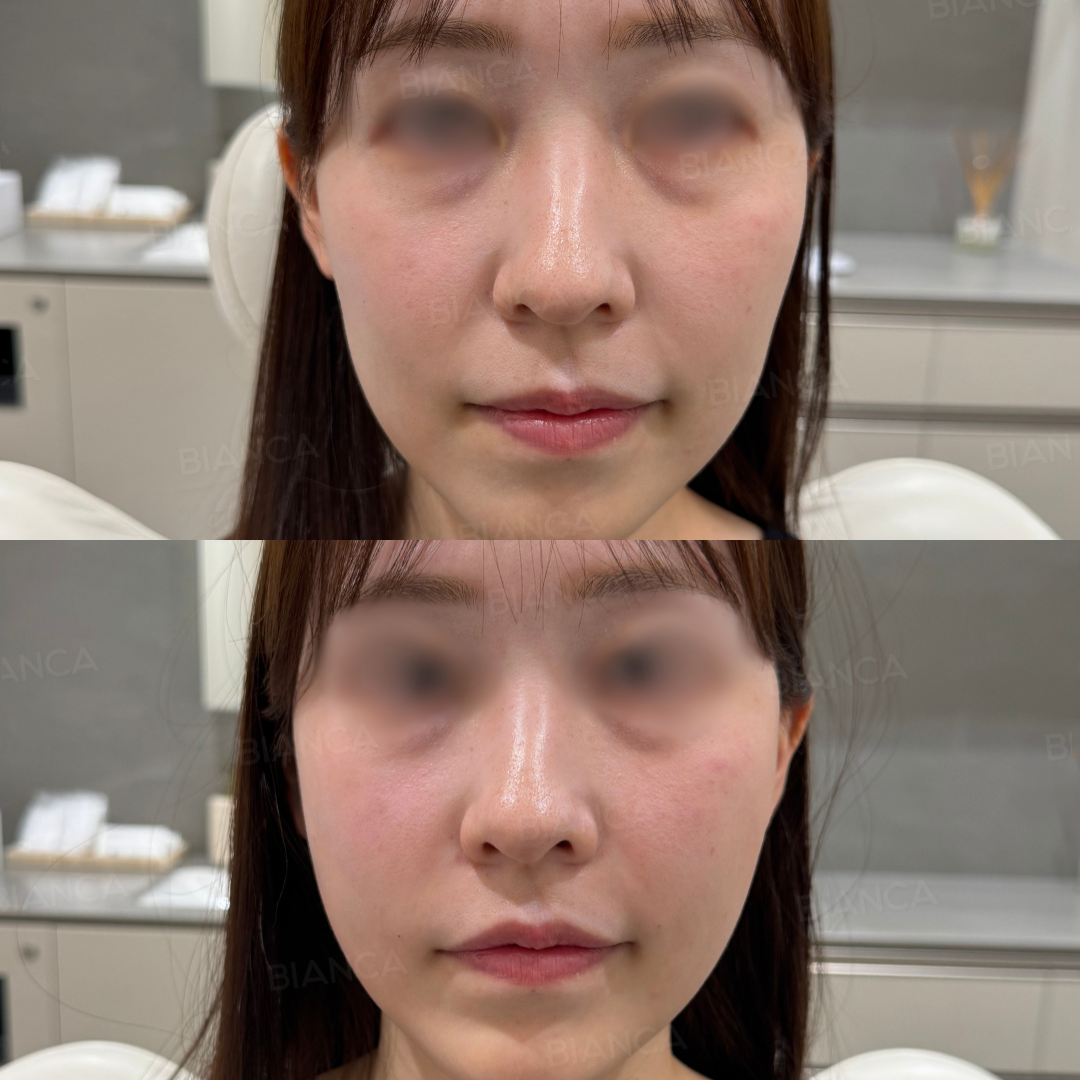 ヒアルロン酸注射（頬）