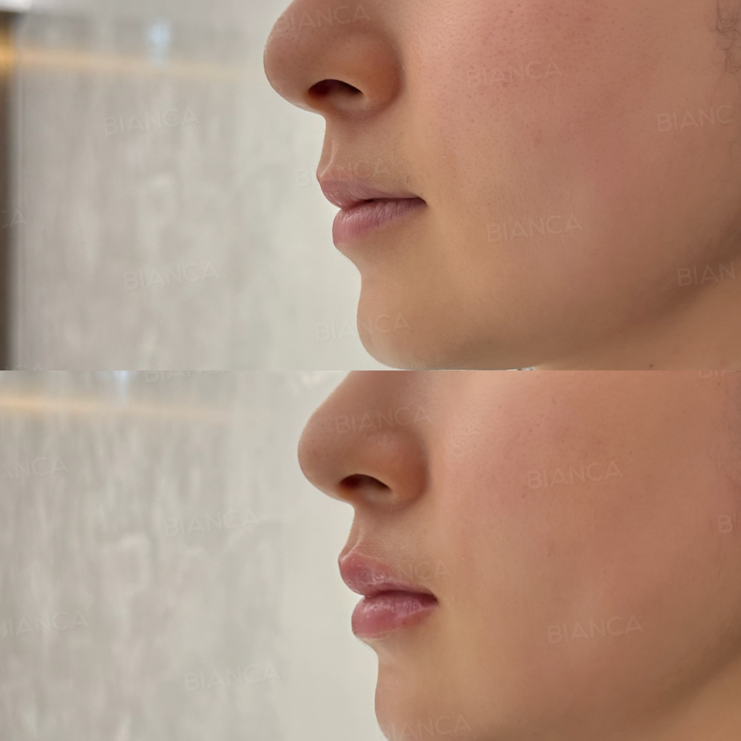 ヒアルロン酸注射（唇）