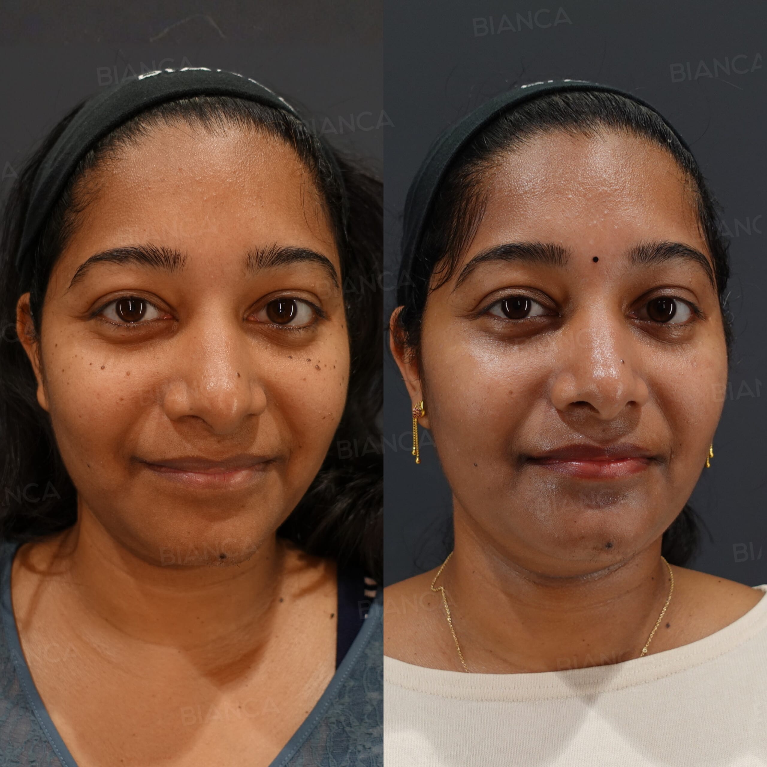 CO2レーザー(ほくろ取り)