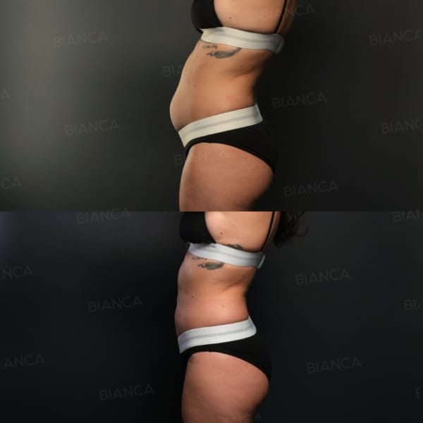 ベイザー(VASER)ボディ脂肪吸引(全腹部+腰部)｜銀座・表参道にあるBIANCA CLINIC ビアンカクリニック｜美容外科・美容皮膚科・再生医療・美容婦人科・美容内科・医療アートメイク