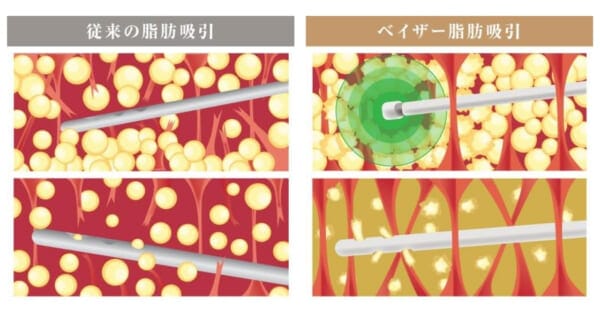 ベイザー脂肪吸引と従来の脂肪吸引の違いを説明する画像