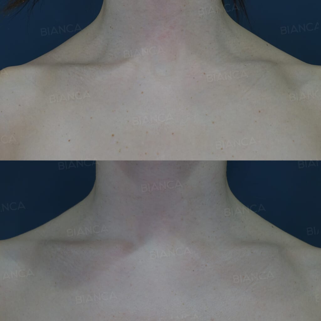 CO2レーザー(ほくろ取り）