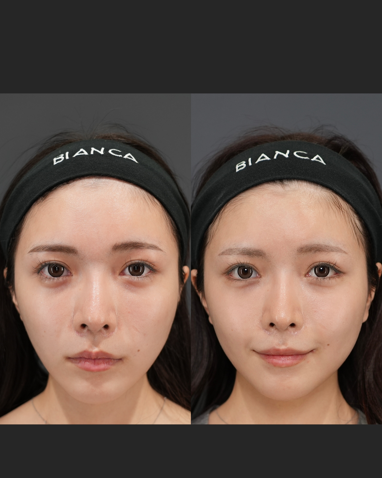 タレ目尻切開 ・グラマラスライン形成 ・裏ハムラ法