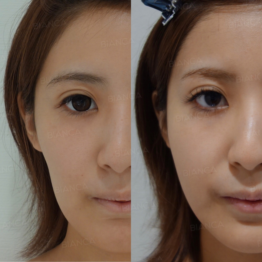 ヒアルロン酸注射（頬）