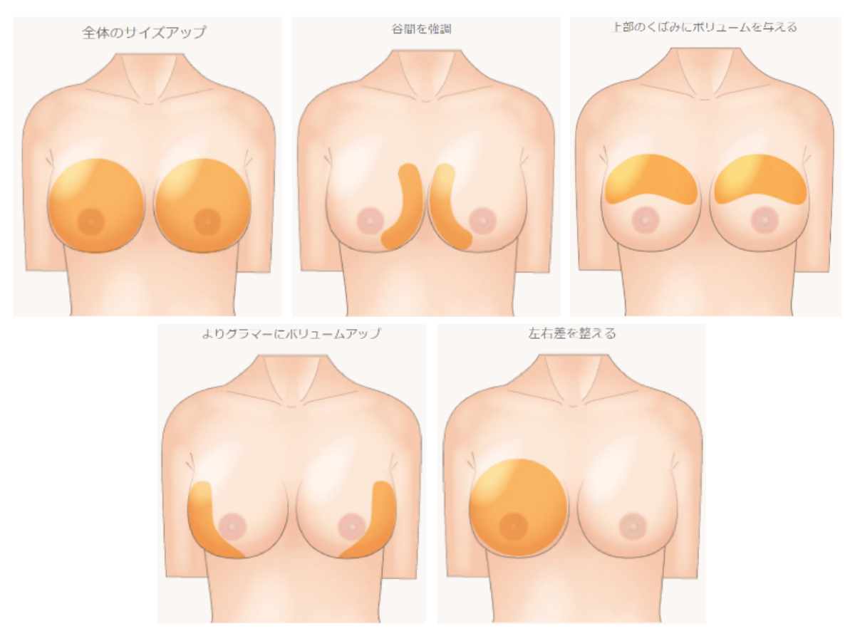  下垂や左右差といった形状のお悩みも解消