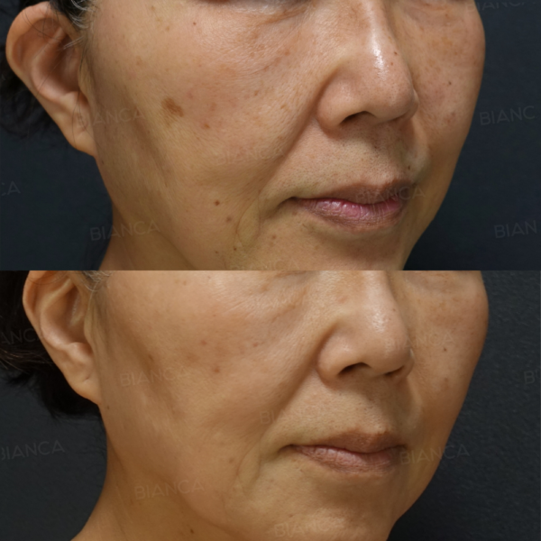 ピコスポット、ピコトーニング｜銀座・表参道にあるBIANCA CLINIC ビアンカクリニック｜美容外科・美容皮膚科・再生医療・美容婦人科・美容内科・医療アートメイク