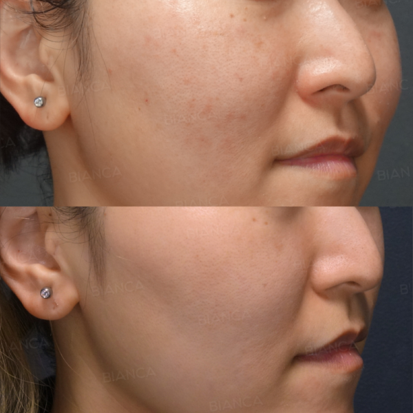 ピコスポット、ピコトーニング｜銀座・表参道にあるBIANCA CLINIC ビアンカクリニック｜美容外科・美容皮膚科・再生医療・美容婦人科・美容内科・医療アートメイク