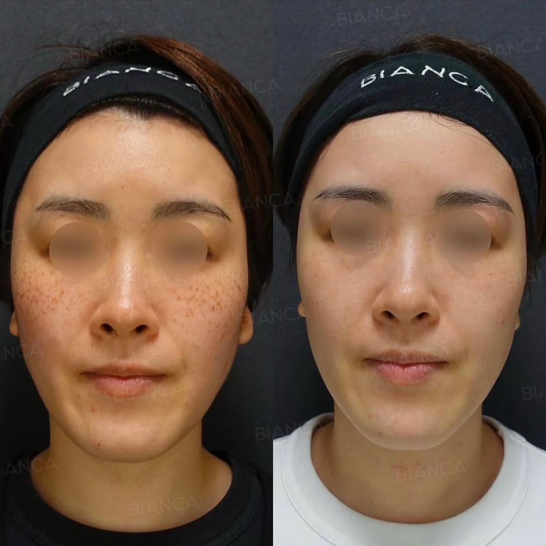 ピコスポット全顔打ち放題 ・ピコトーニング