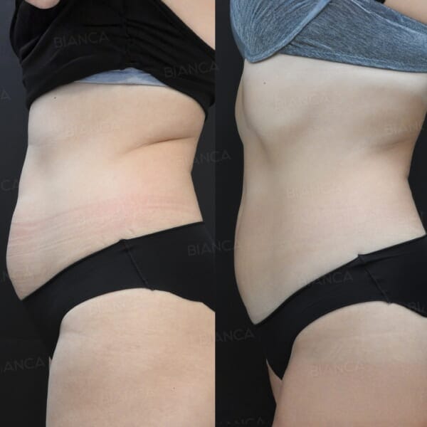 AlmaPrimeXボディ腹部｜銀座・表参道にあるBIANCA CLINIC ビアンカクリニック｜美容外科・美容皮膚科・再生医療・美容婦人科・美容内科・医療アートメイク