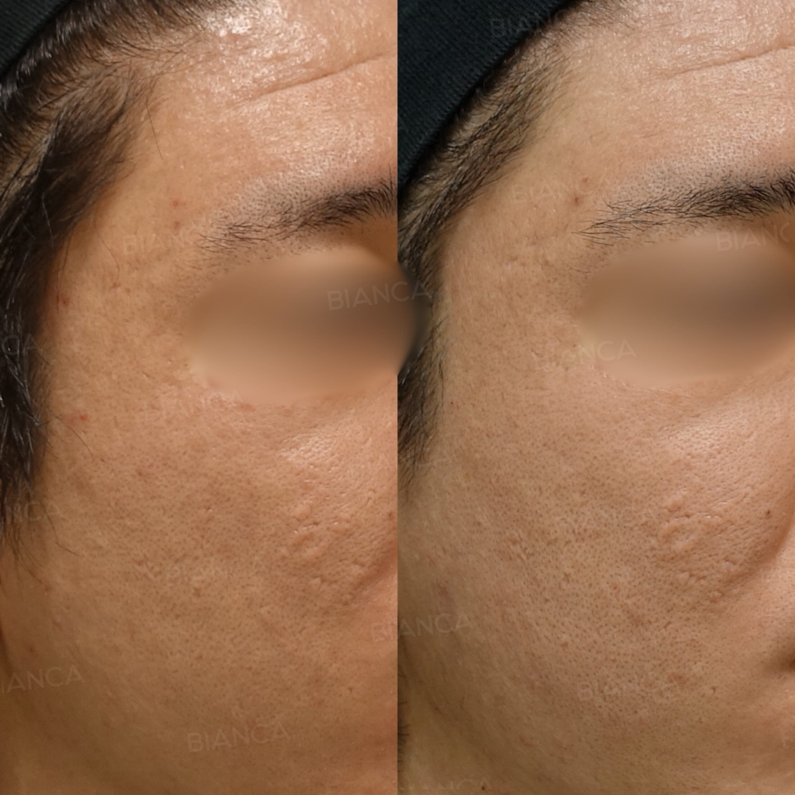 トライフィルプロ