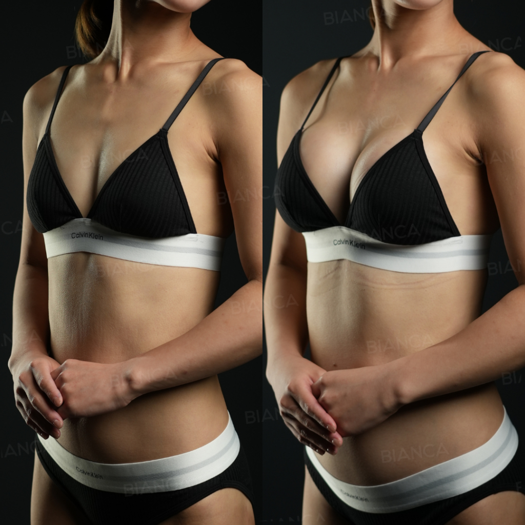 シリコンバック豊胸(PRESERVé™ )