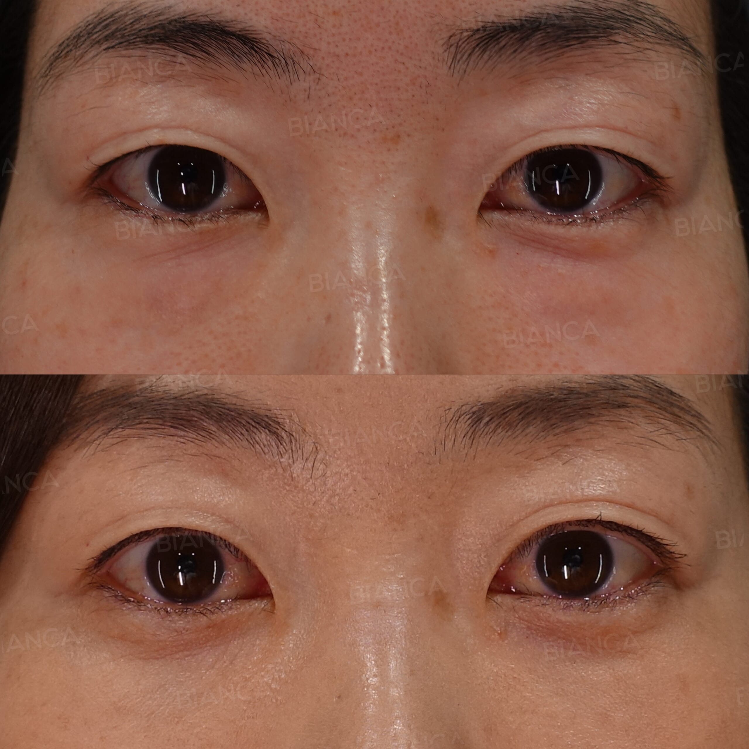 目の下クマ・たるみ取り（経結膜脱脂術）