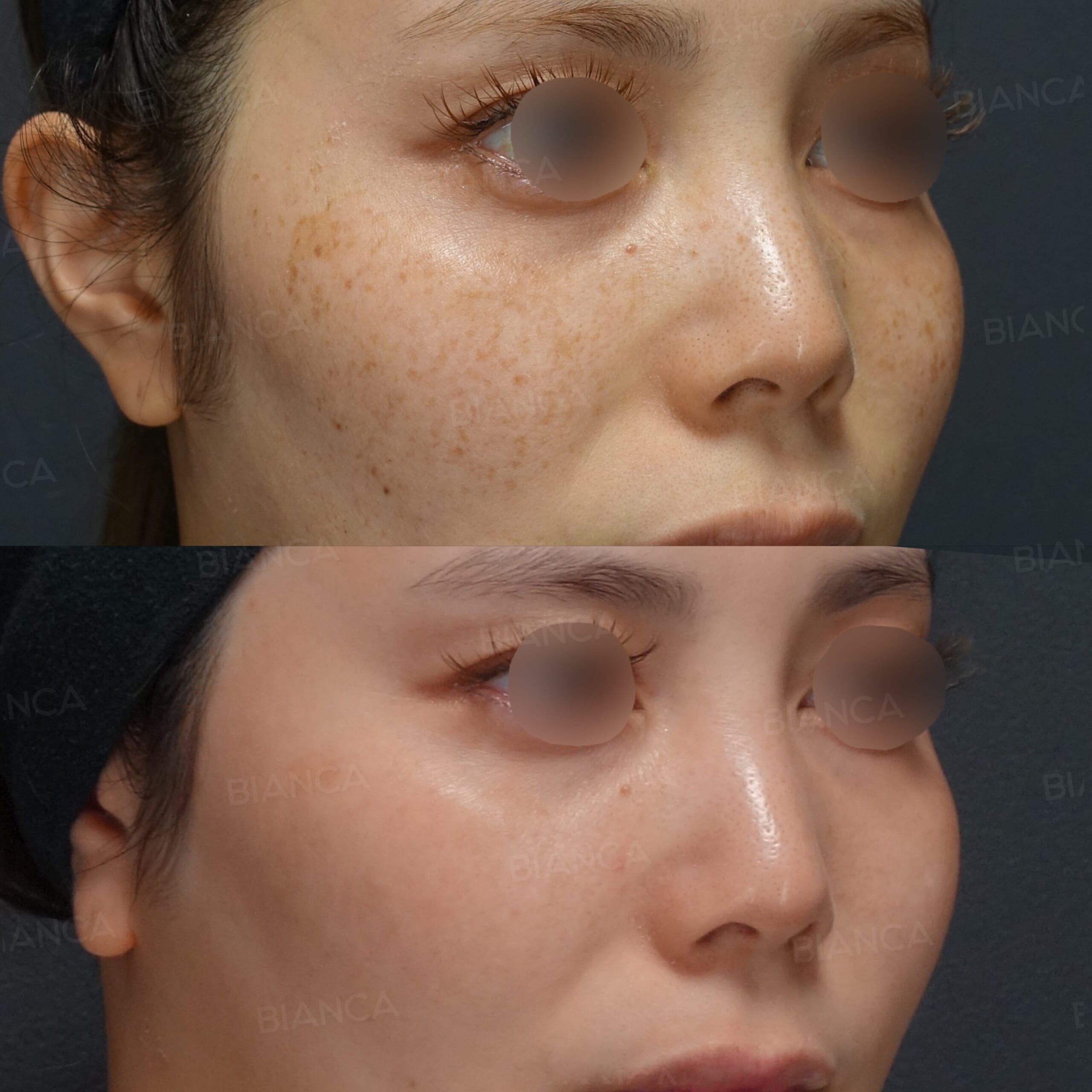 ピコスポット、ピコトーニング