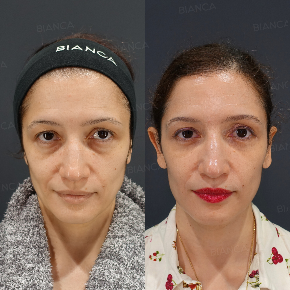 裏ハムラ法、上瞼たるみ取り