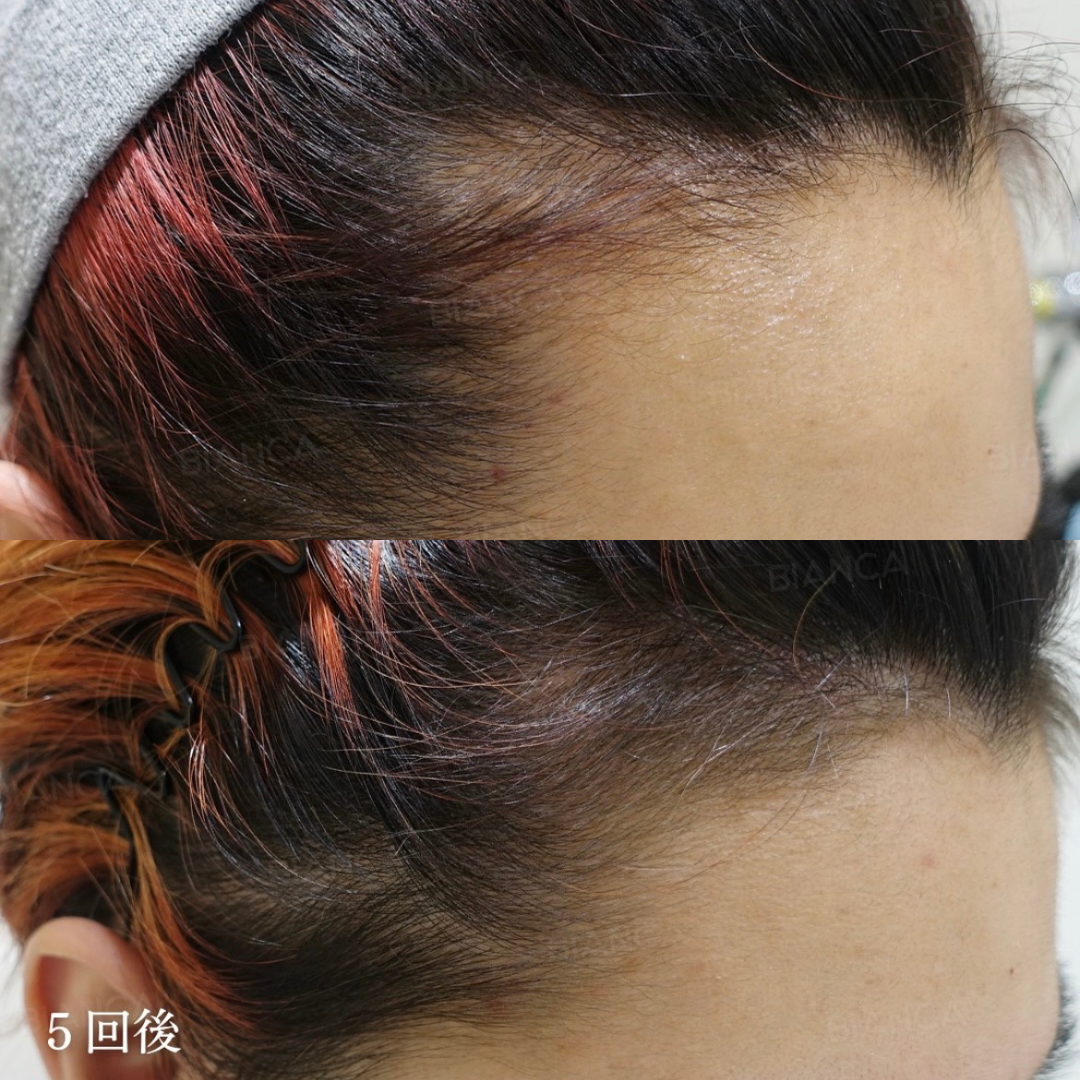 プルリアルヘアデンシティ（頭皮）