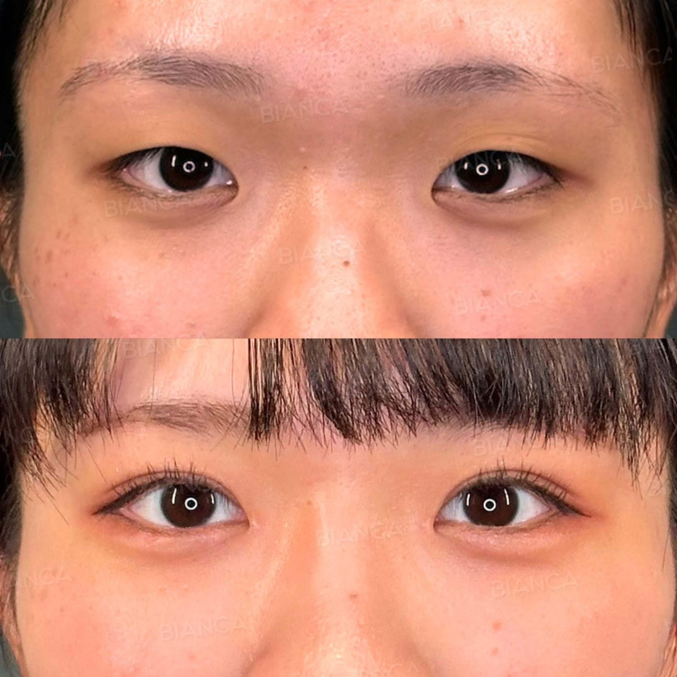 二重埋没法（裏留め）B TWICE・目頭切開