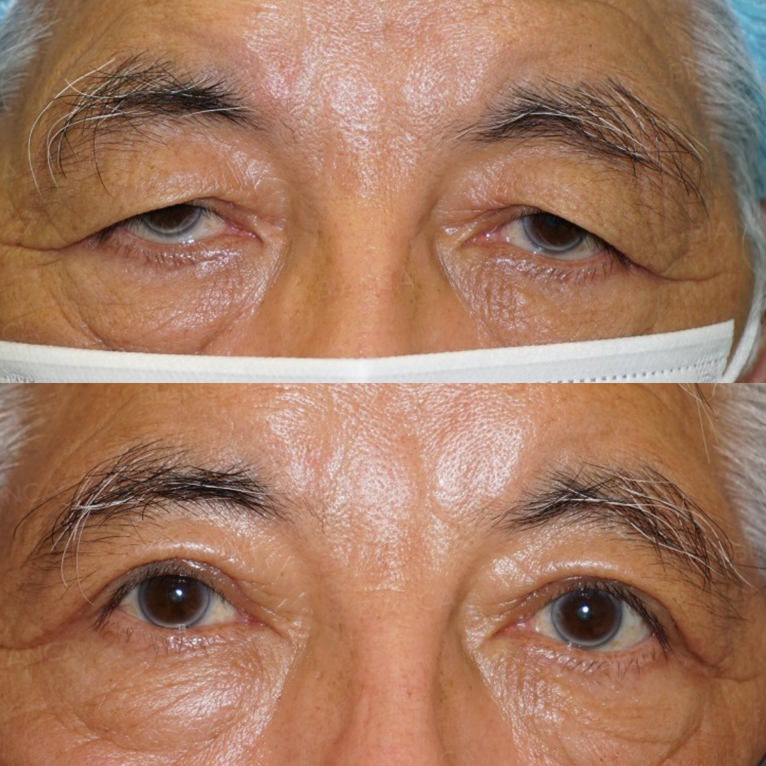 眼瞼下垂切開法