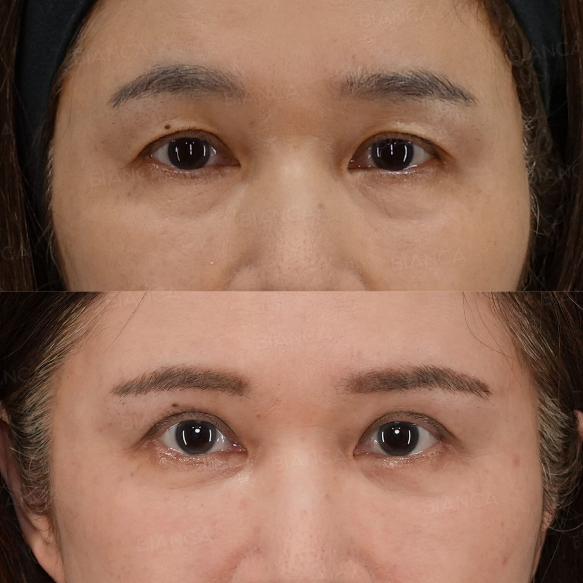眉下切開、裏ハムラ法