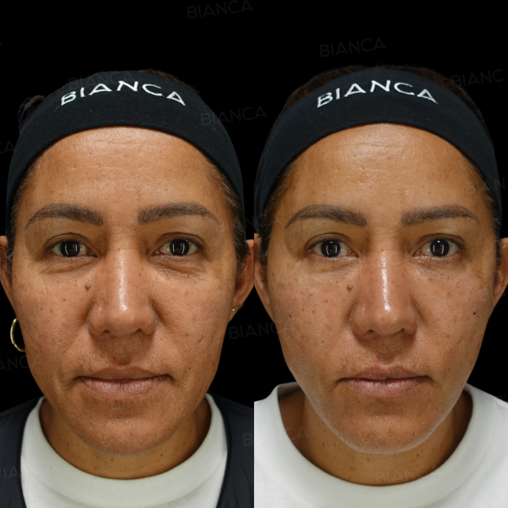 アルテミスリフト、ベビーダーム