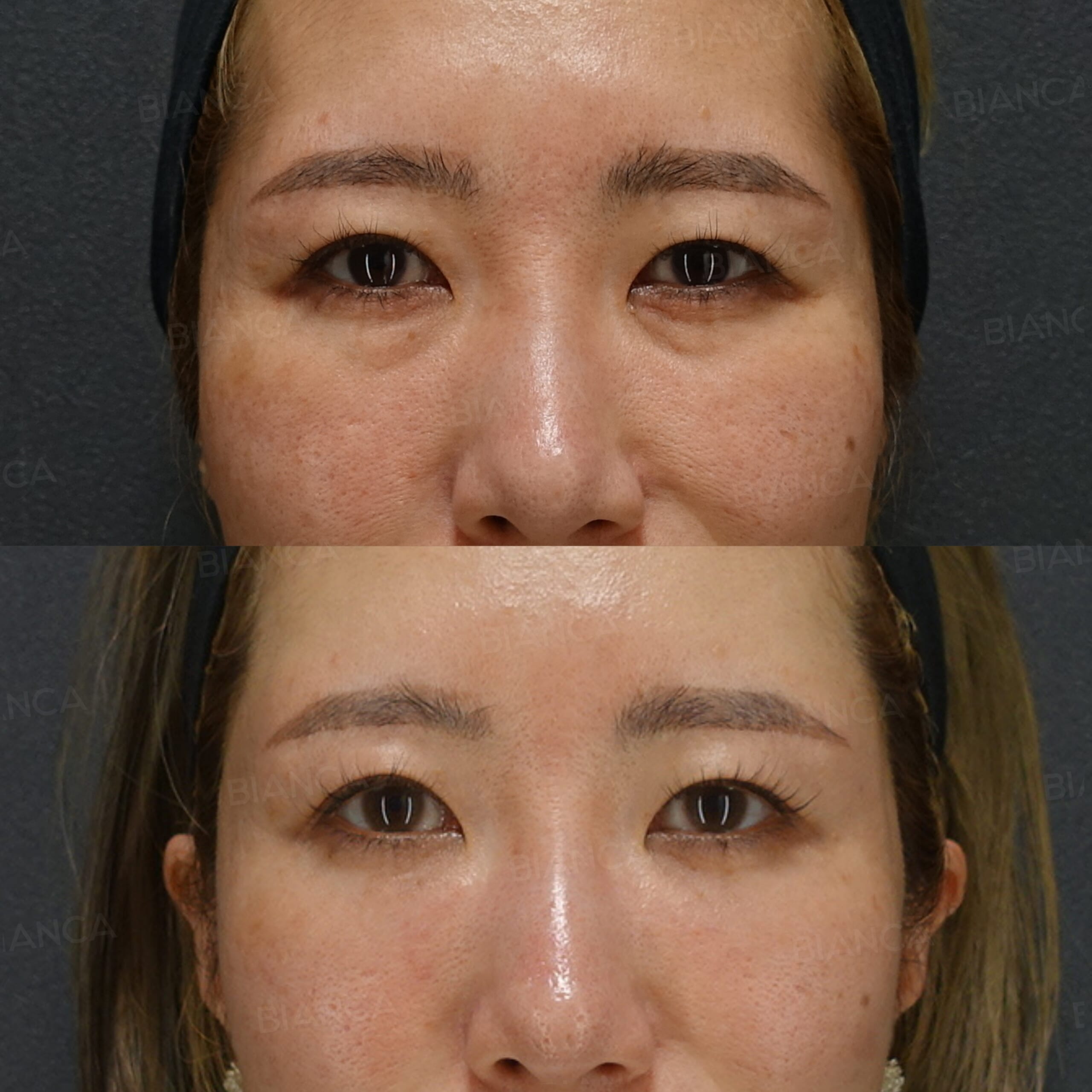 目の下クマ・たるみ取り・ヒアルロン酸注射（涙袋）