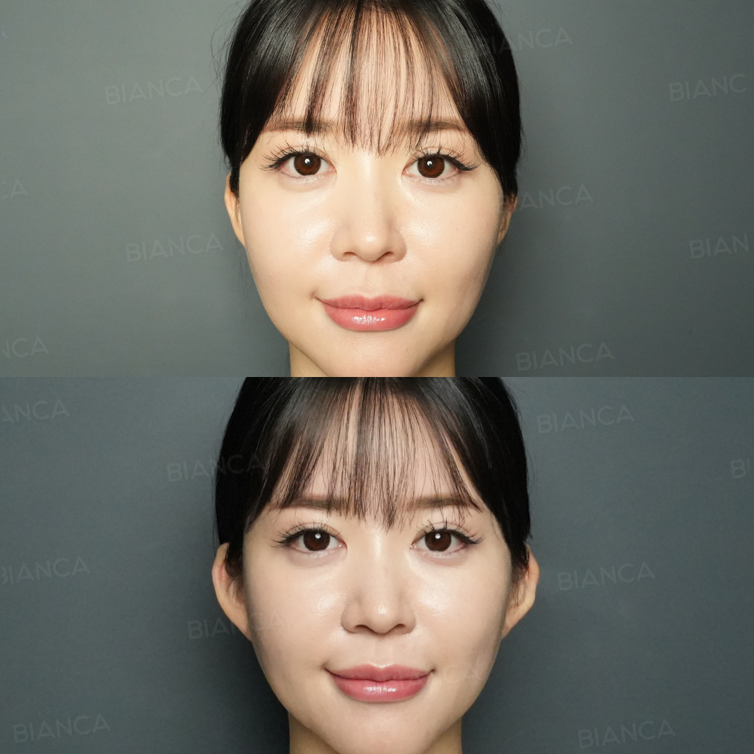 立ち耳ヒアルロン酸注射