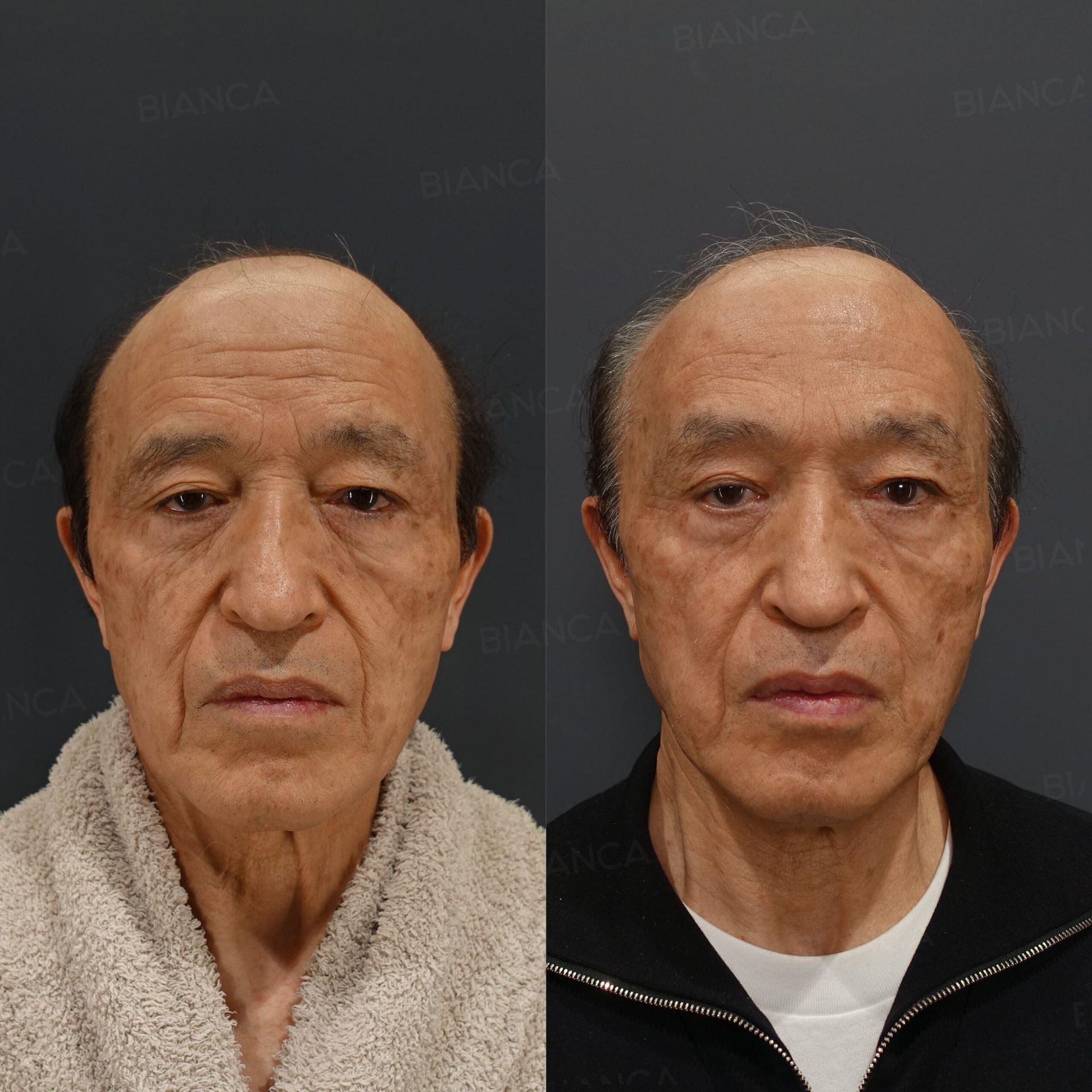 前額リフト