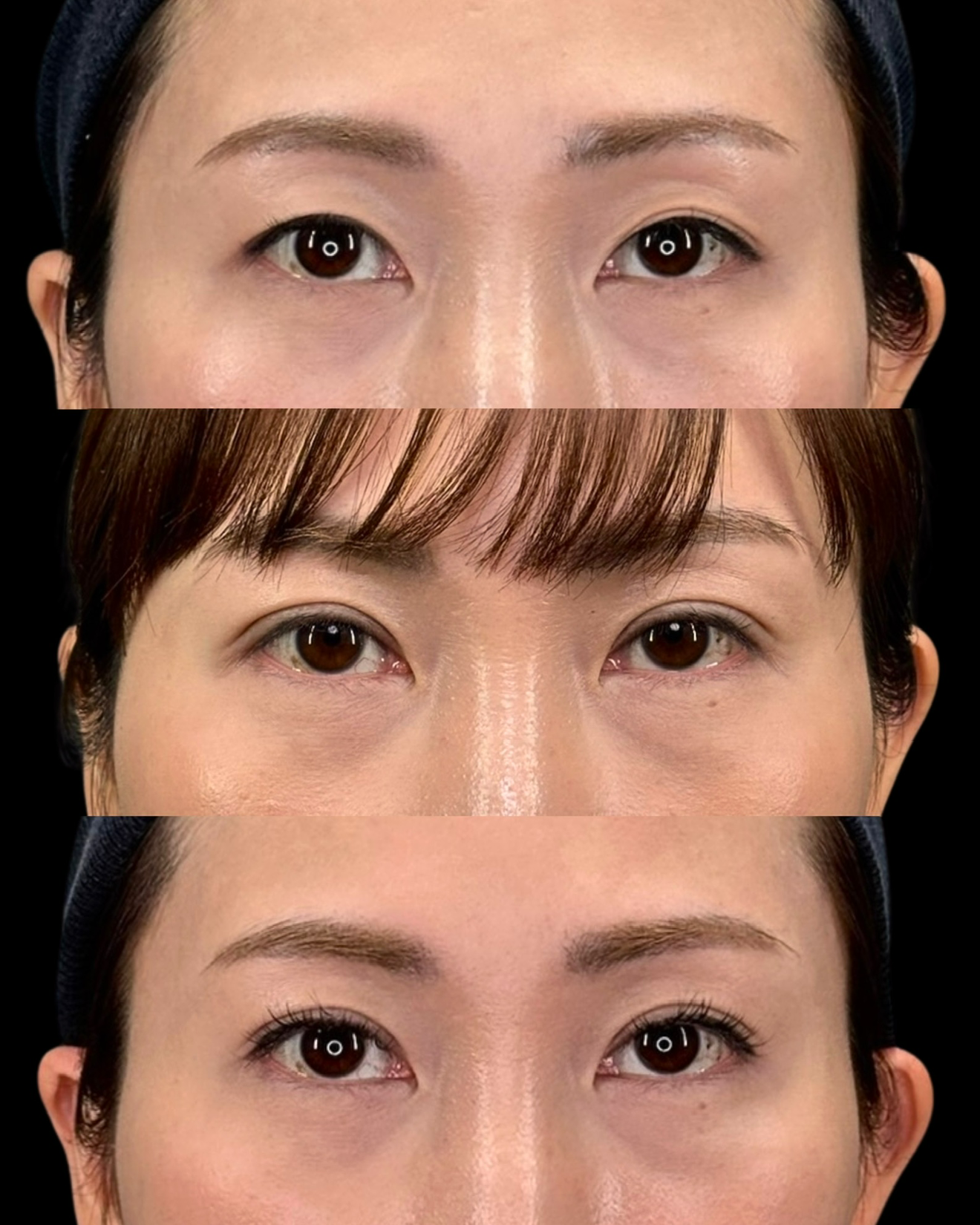 二重埋没法4点留め