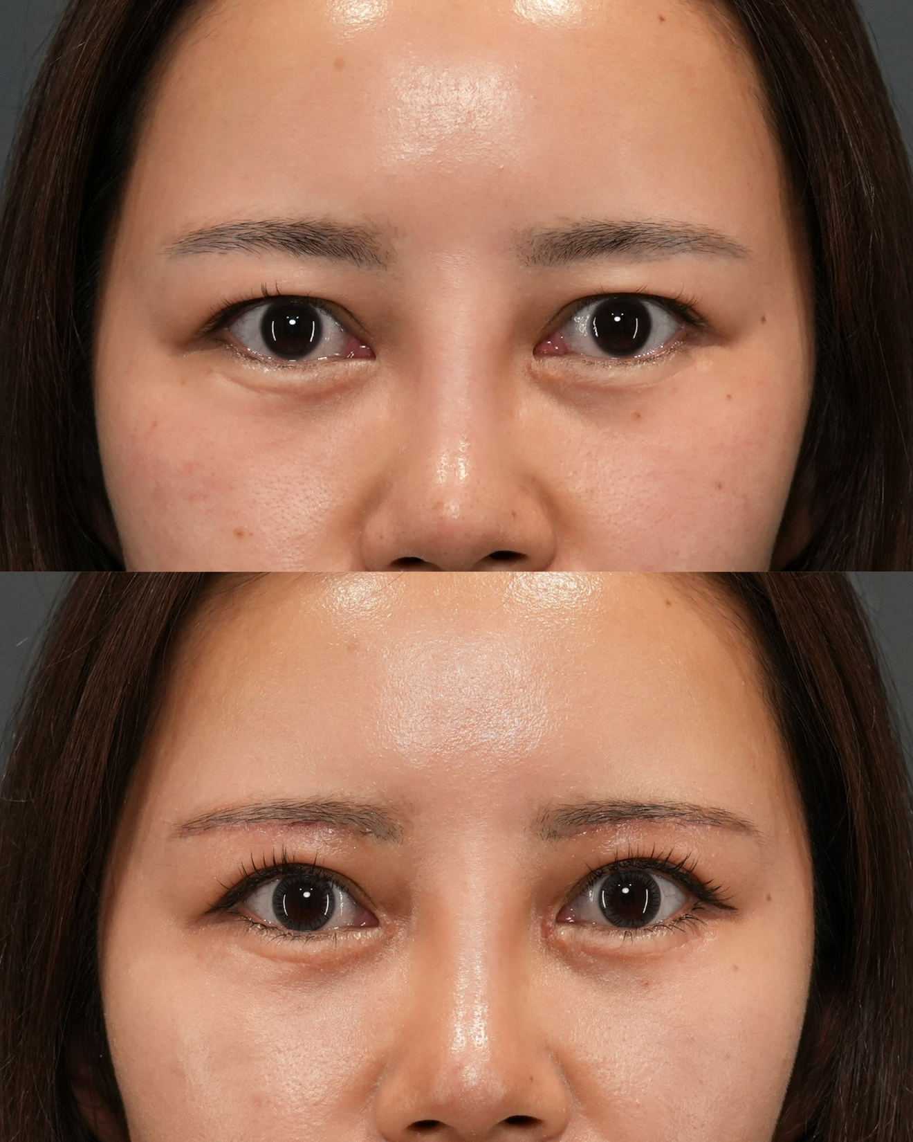 眉下切開 ・蒙古襞形成（VY法）