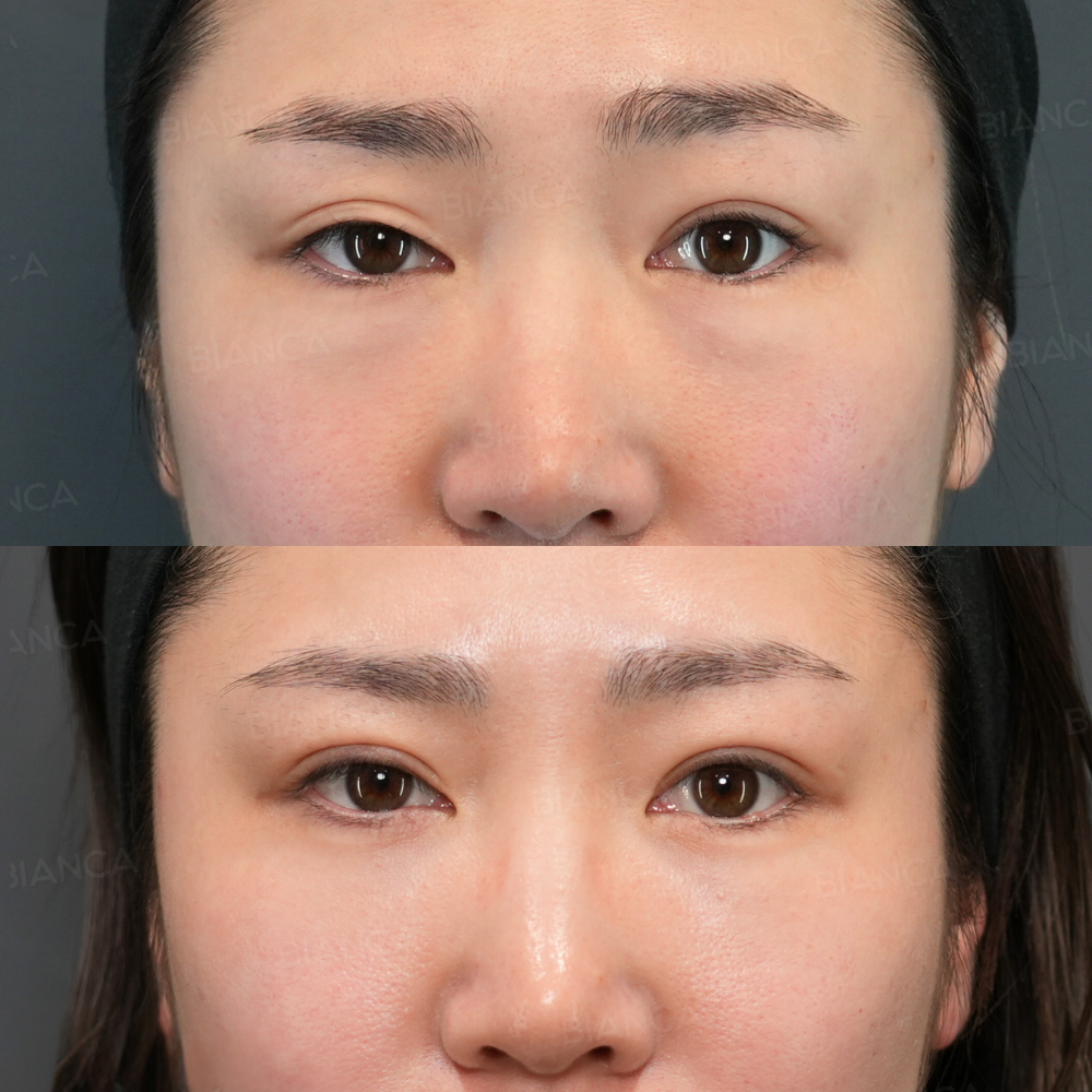 裏ハムラ法、二重埋没4点留め