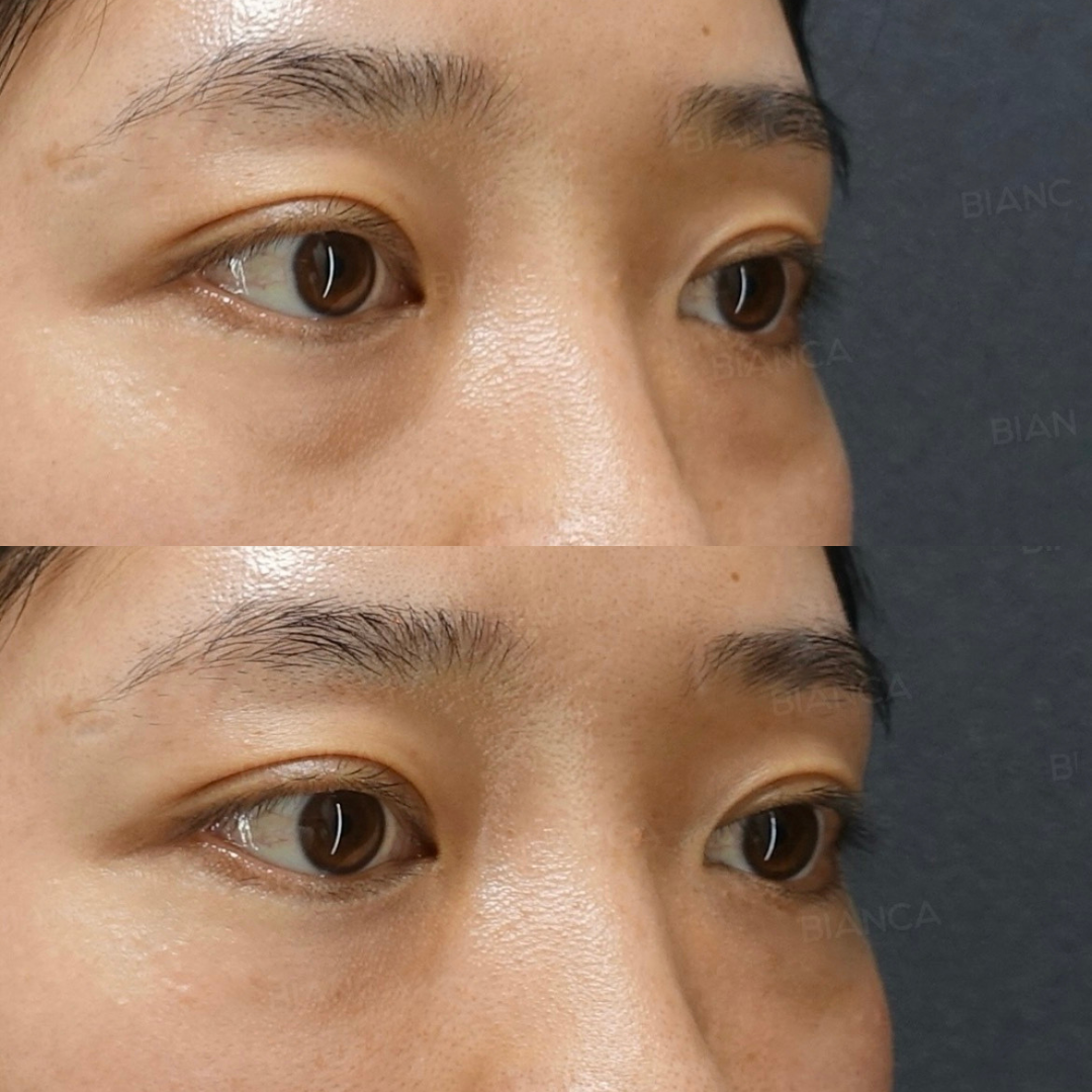 ベビーコラーゲン（目の下）