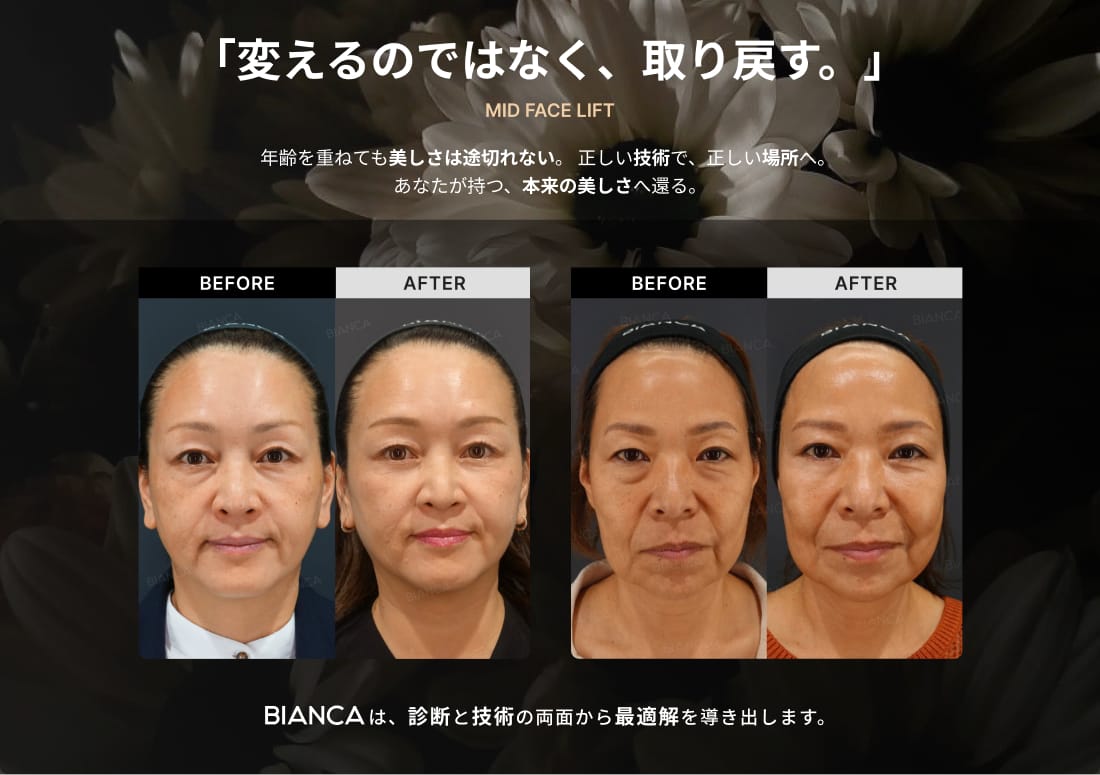 BIANCA CLINIC ビアンカクリニックのミッドフェイスリフト 症例写真