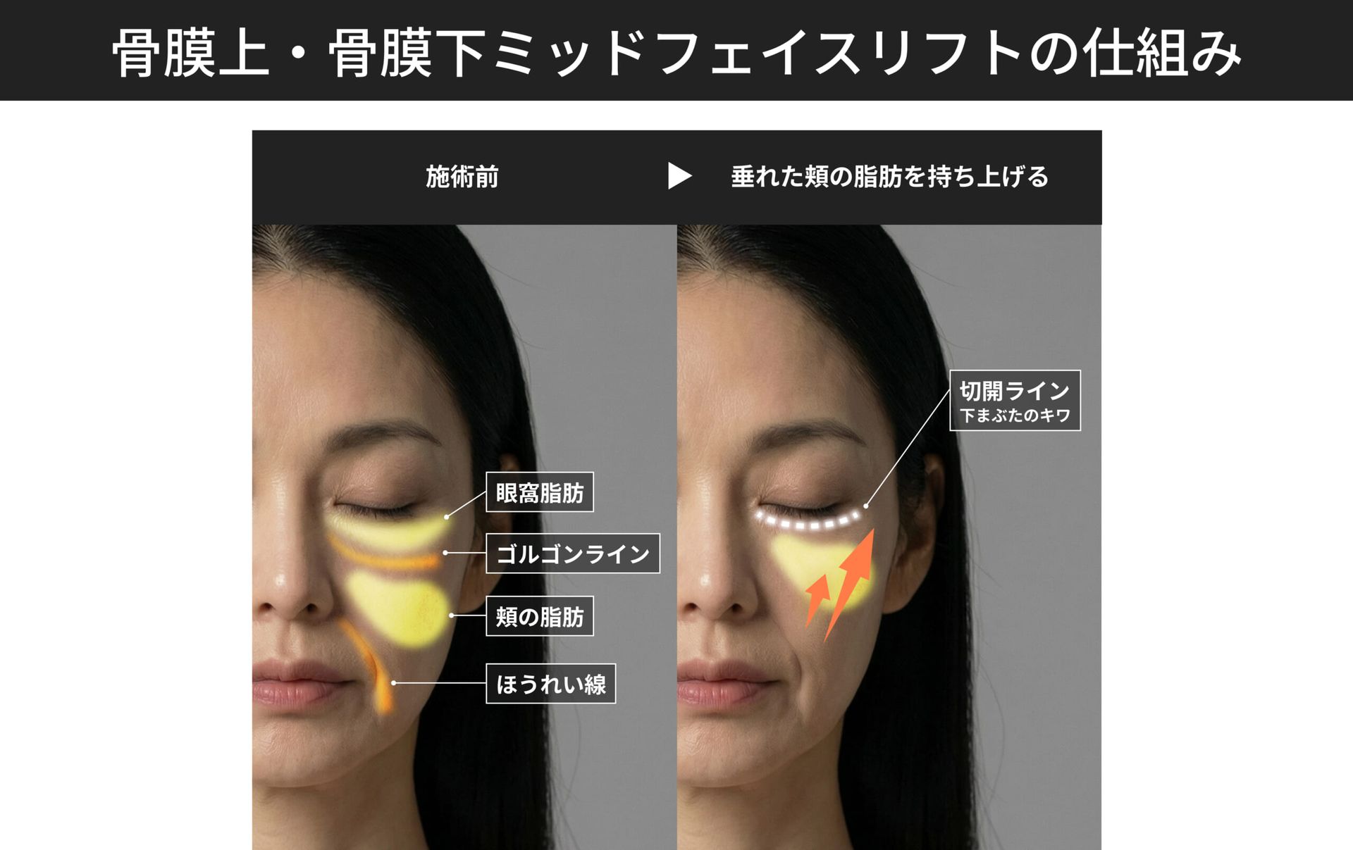 骨膜上・骨膜下ミッドフェイスリフトの仕組み
