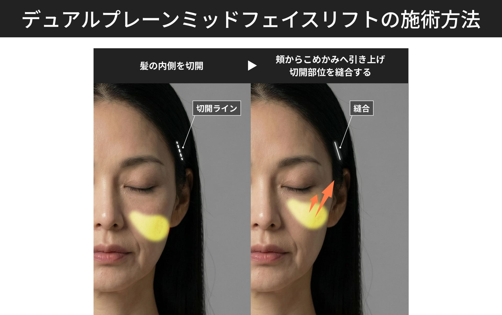 デュアルプレーンミッドフェイスリフトの施術方法