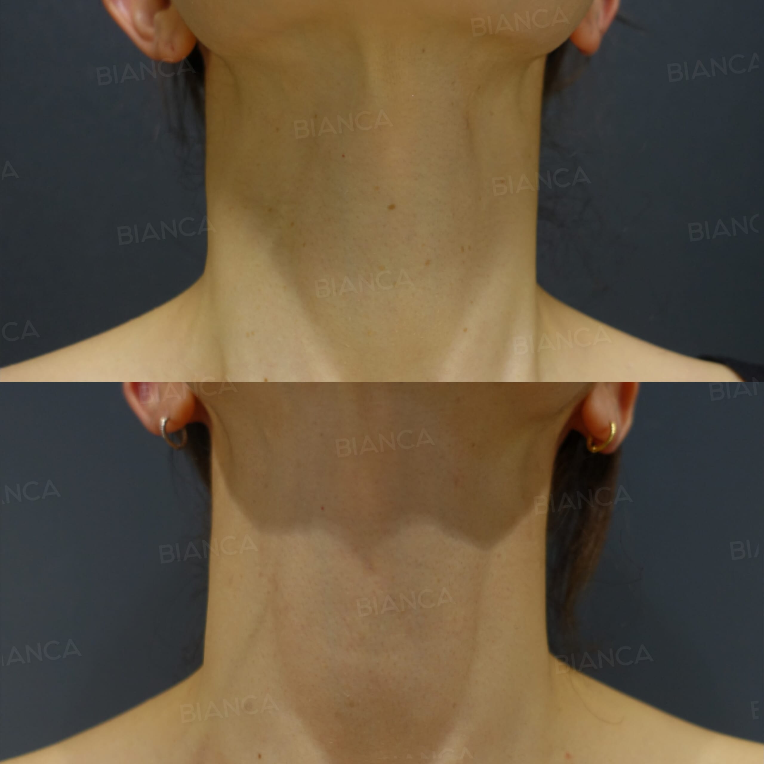 CO2レーザー(ほくろ取り)