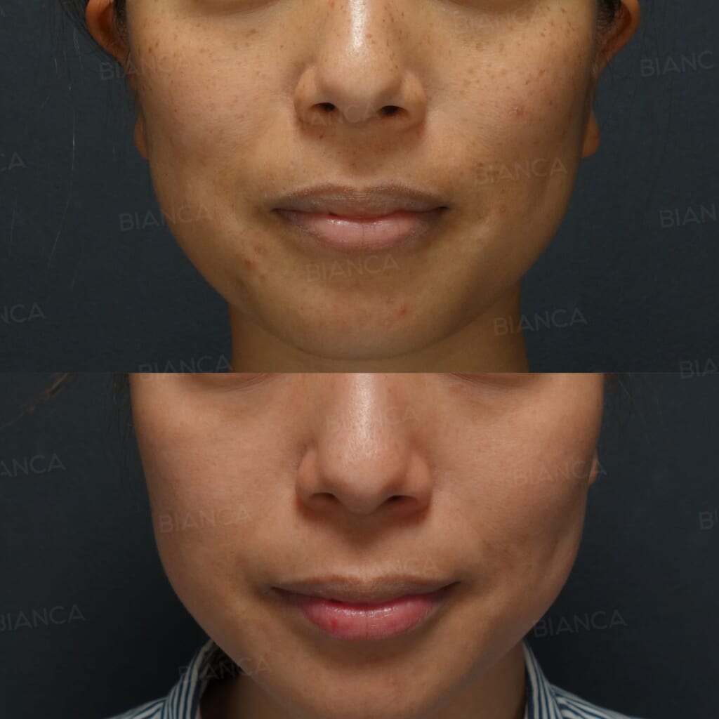 ピコスポット、ピコトーニング