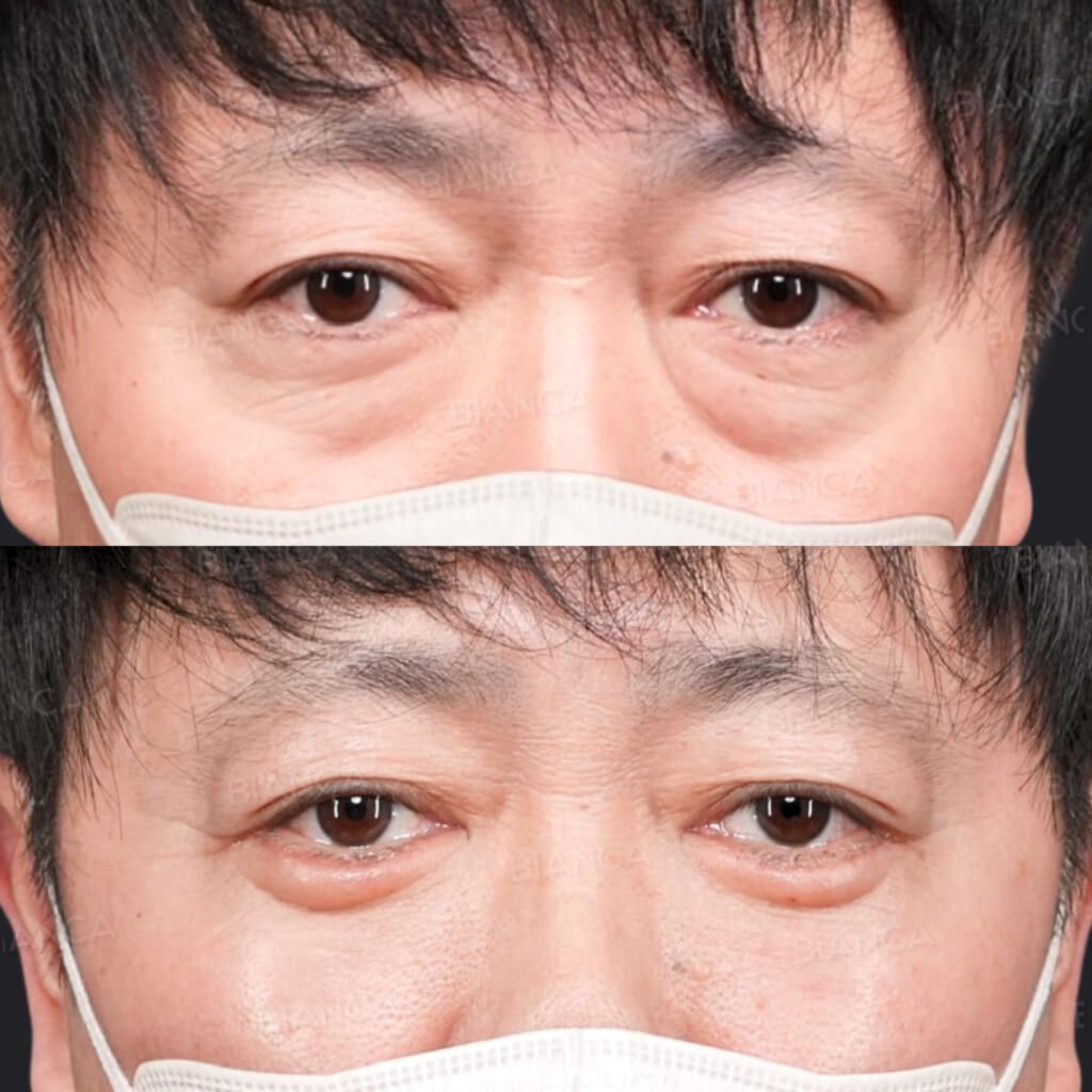 ハムラ法 