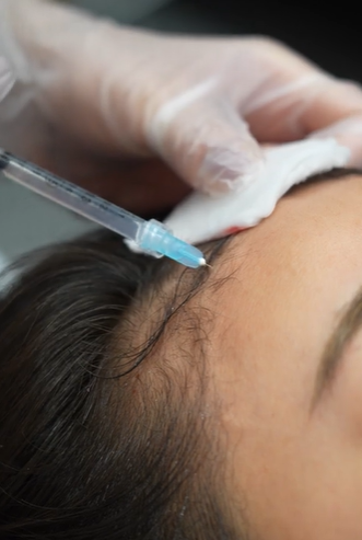 毛髪再生 浄化濃縮幹細胞培養上清液注射とは