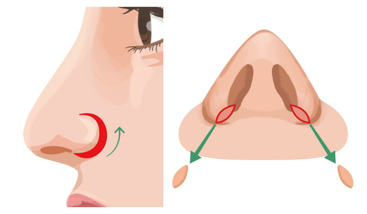 鼻翼挙上と鼻翼縮小の違い