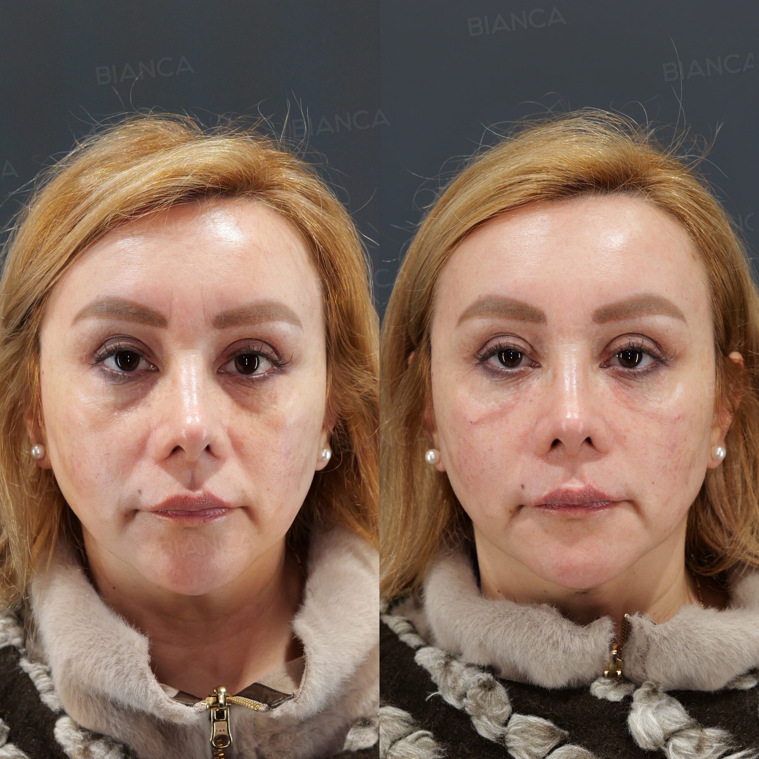 ベビーコラーゲン（目の下）